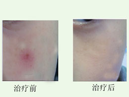 肝病蜘蛛痣